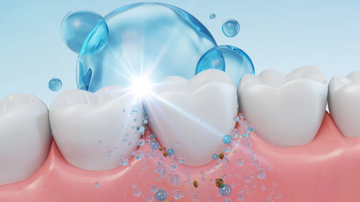 dr.consulta - Ilustração de dente recebendo flúor.