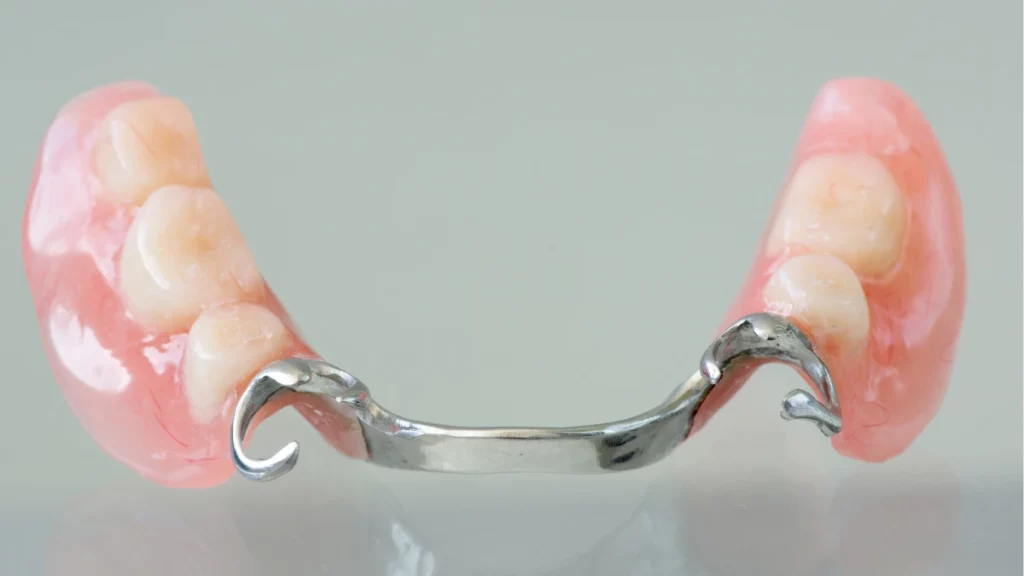 dr.consulta - Imagem de prótese parcial removível com dentes molares.