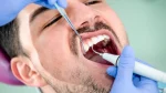 dr.consulta - Homem com a boca aberta durante raspagem no dente.