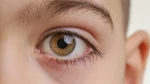 dr.consulta - Na imagem, olho de criança com retinoblastoma.