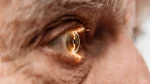 dr.consulta - Na imagem, olho de homem idoso com sintomas do glaucoma.
