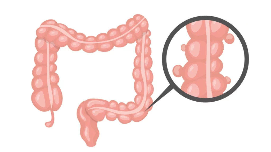 dr.consulta - Ilustração com exemplo de diverticulos, que levam à diverticulose.