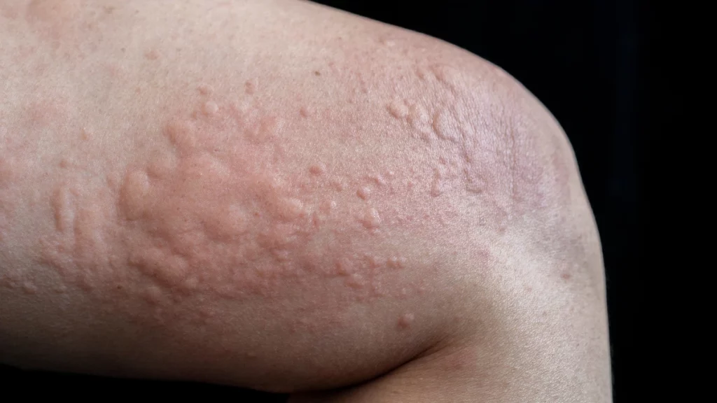 dr.consulta - Perna com Urticária Crônica Espontânea.