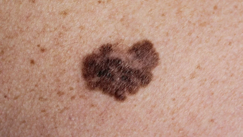 dr.consulta - Mancha na pele escura e com rugosidade, exemplo de câncer de pele melanoma.