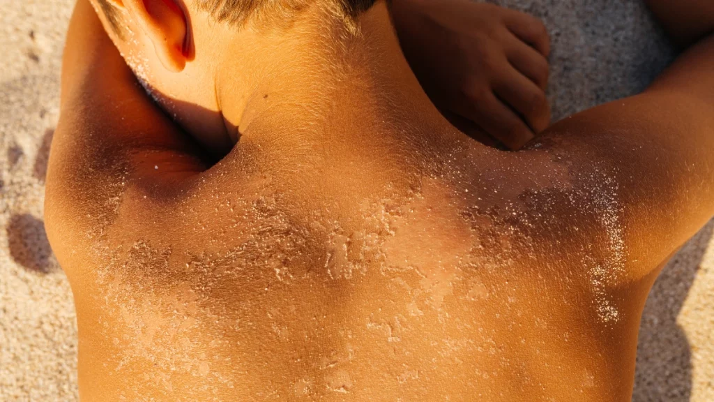 Queimaduras de sol e câncer de pele: saiba como se prevenir