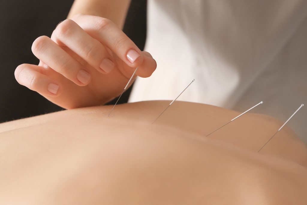 Acupuntura: o que é, para que serve e quando começar o tratamento